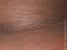 acanthosisNigricans_639_lg